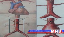 Аневризм буюу судасны цүлхэн