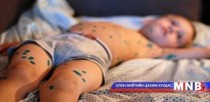 Долоо хоногт 30-40 хүн улаанбурханаар өвчилж байна  