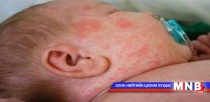 Дархан-Уул аймагт улаанбурхан өвчнөөр 5 хүүхэд нас баржээ