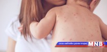 Улаанбурханы эсрэг вакциныг нярай хүүхдэд тарьж болохгүй