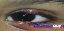 Нүдэнд гарсан өвдөг