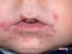 0-4 насныхны дунд гар, хөл, амны өвчний дэгдэлт өндөр байна   