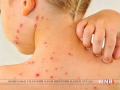 Салхинцэцэг өвчний шинж тэмдэг