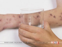 1-3 сард менингит өвчний вирусын дэгдэлт их байдаг 