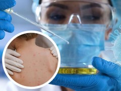 Дэлхий даяар сармагчны цэцэг өвчний 550 гаруй тохиолдол батлагджээ 