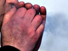 Гэмтлийн эмнэлэгт осголт, хөлдөлтийн шалтгаанаар хоногт 10 гаруй өвчтөн ирж байна