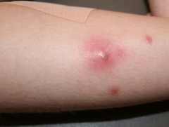 МРСА халдварыг зөвхөн шинжилгээгээр оношилно