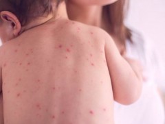    ХӨСҮТ: Улаанбурхан өвчний батлагдсан тохиолдол нэгээр  нэмэгджээ