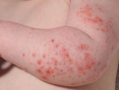 ХӨСҮТ: Монгол Улсын хэмжээнд менингококкт халдварын батлагдсан 5 тохиолдол бүртгэгджээ